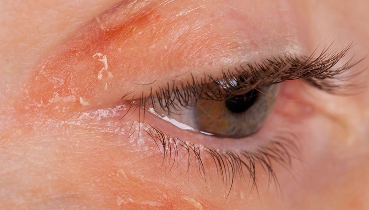 Блефарит — разновидность заболеваний глаз воспалительного характера